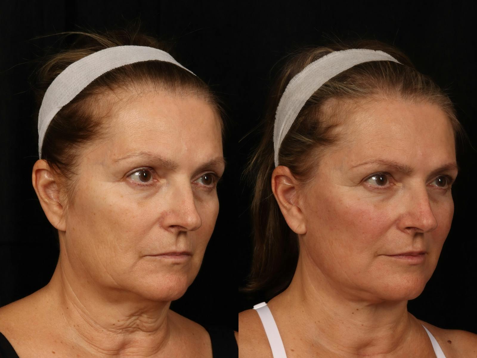 Facelift Before & After Gallery - Patient 319584 - Image 5