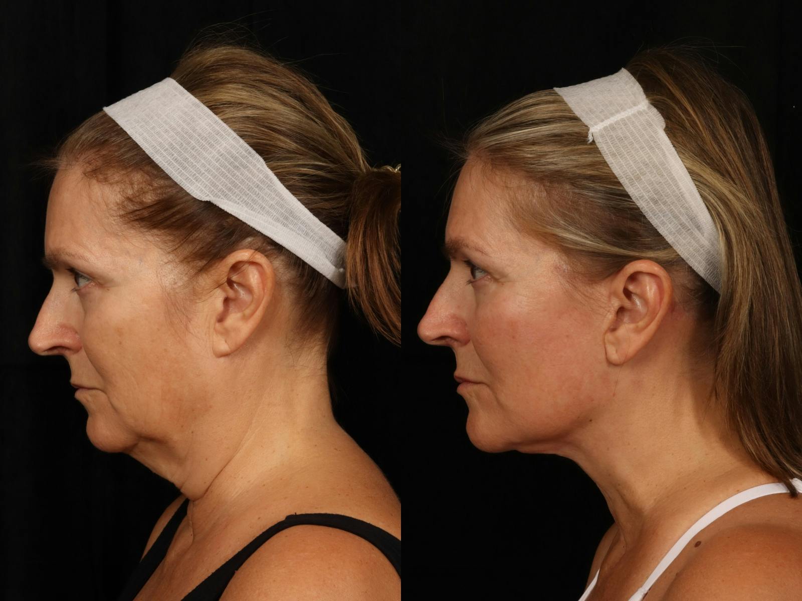 Facelift Before & After Gallery - Patient 319584 - Image 3