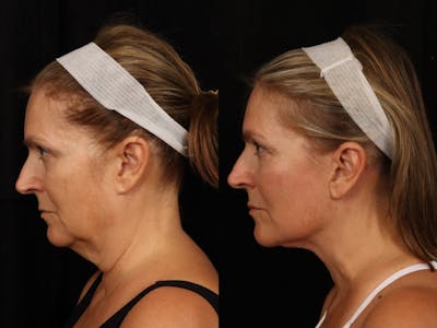 Facelift Before & After Gallery - Patient 319584 - Image 3