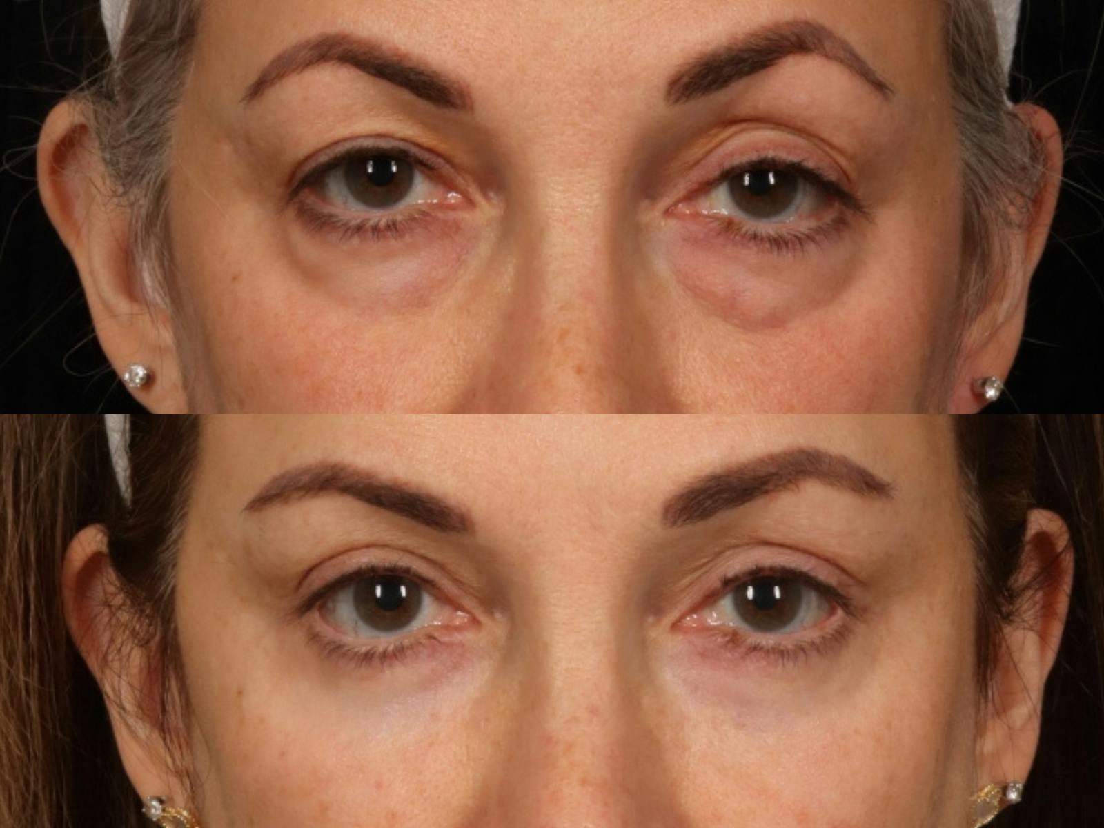 Blepharoplasty Before & After Gallery - Patient 272798 - Image 2