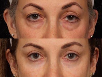 Blepharoplasty Before & After Gallery - Patient 272798 - Image 2
