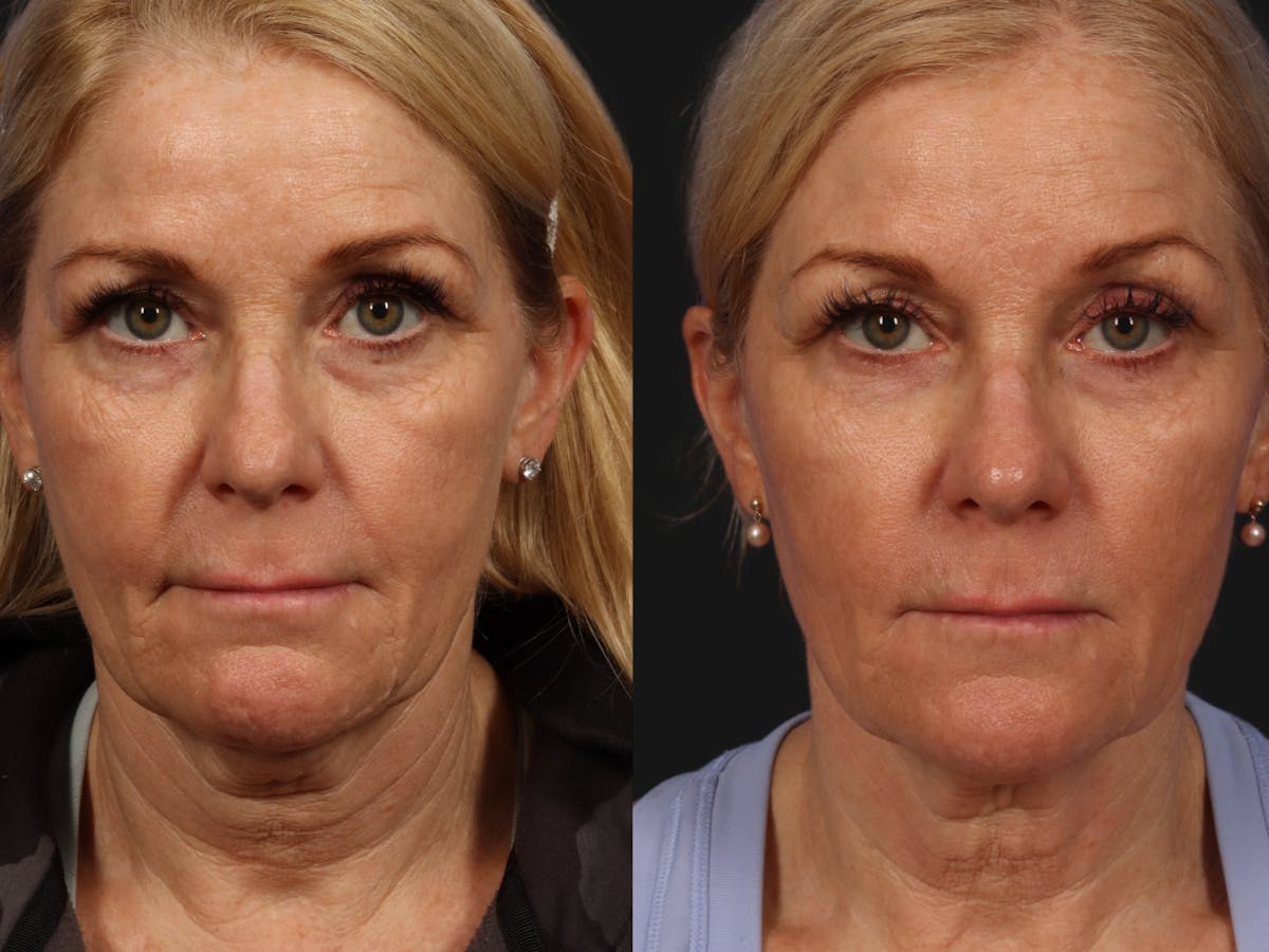 Radiofrequency Microneedling (Morpheus8) Before & After Gallery - Patient 134042 - Image 1