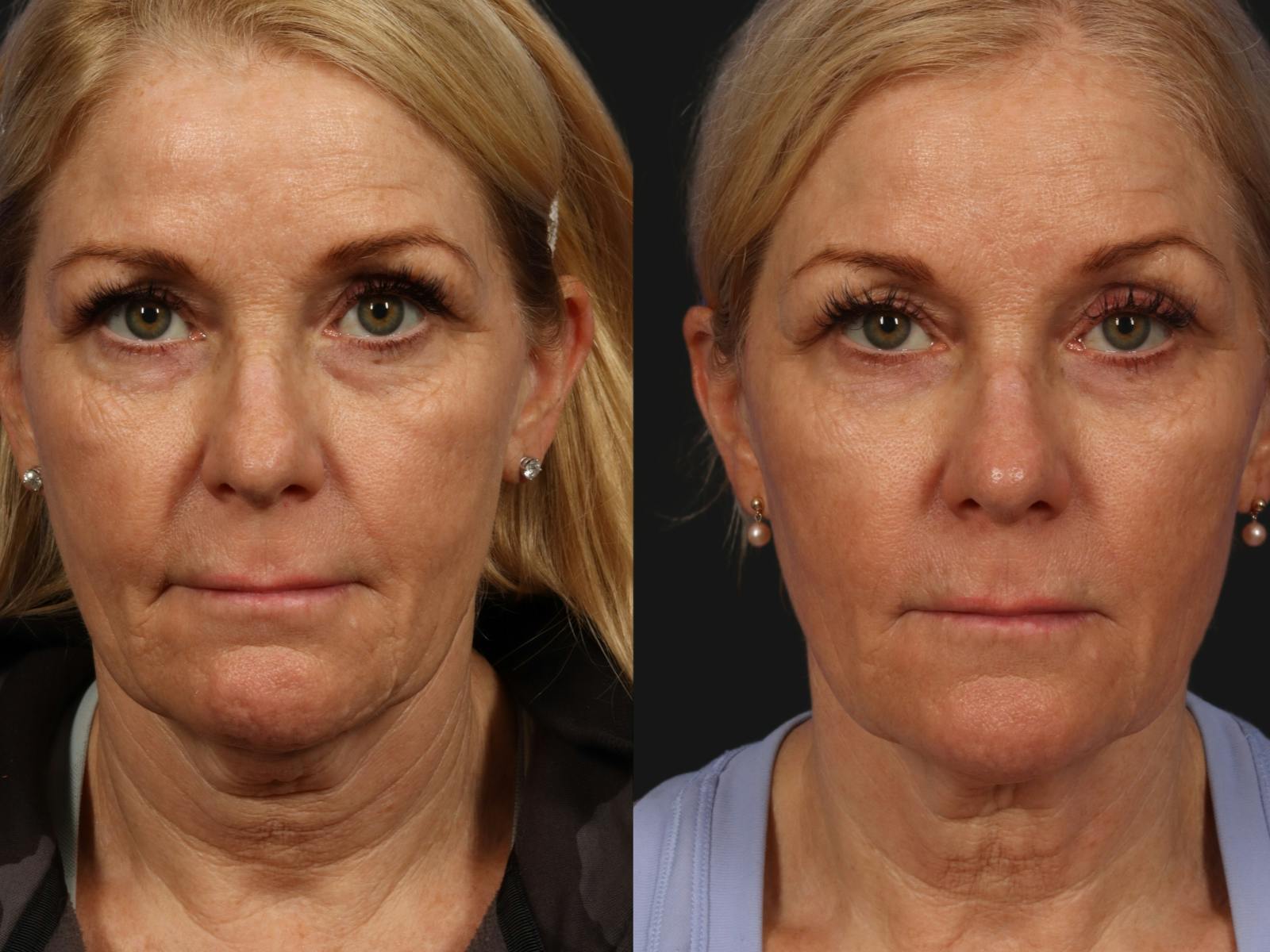 Radiofrequency Microneedling (Morpheus8) Before & After Gallery - Patient 134042 - Image 1