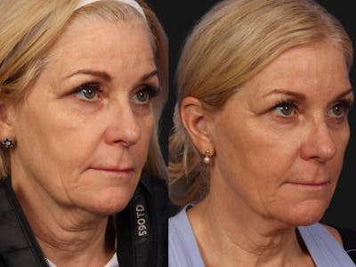 Radiofrequency Microneedling (Morpheus8) Before & After Gallery - Patient 134042 - Image 2