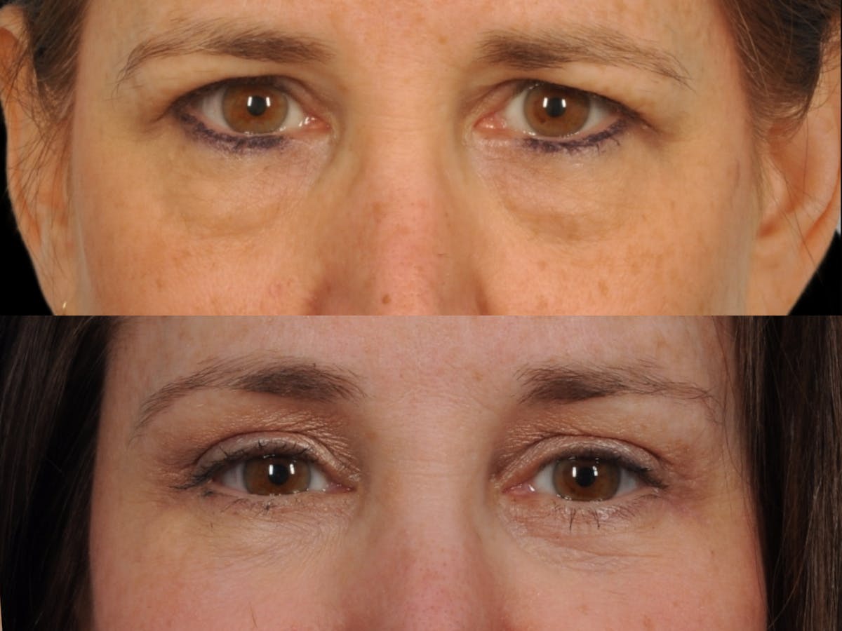 Brow Lift Before & After Gallery - Patient 398847 - Image 2