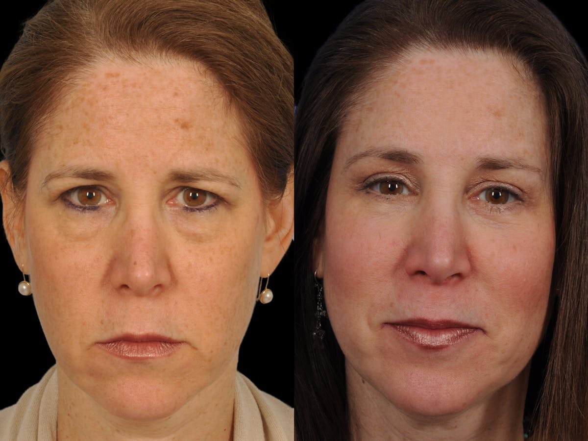 Brow Lift Before & After Gallery - Patient 398847 - Image 1