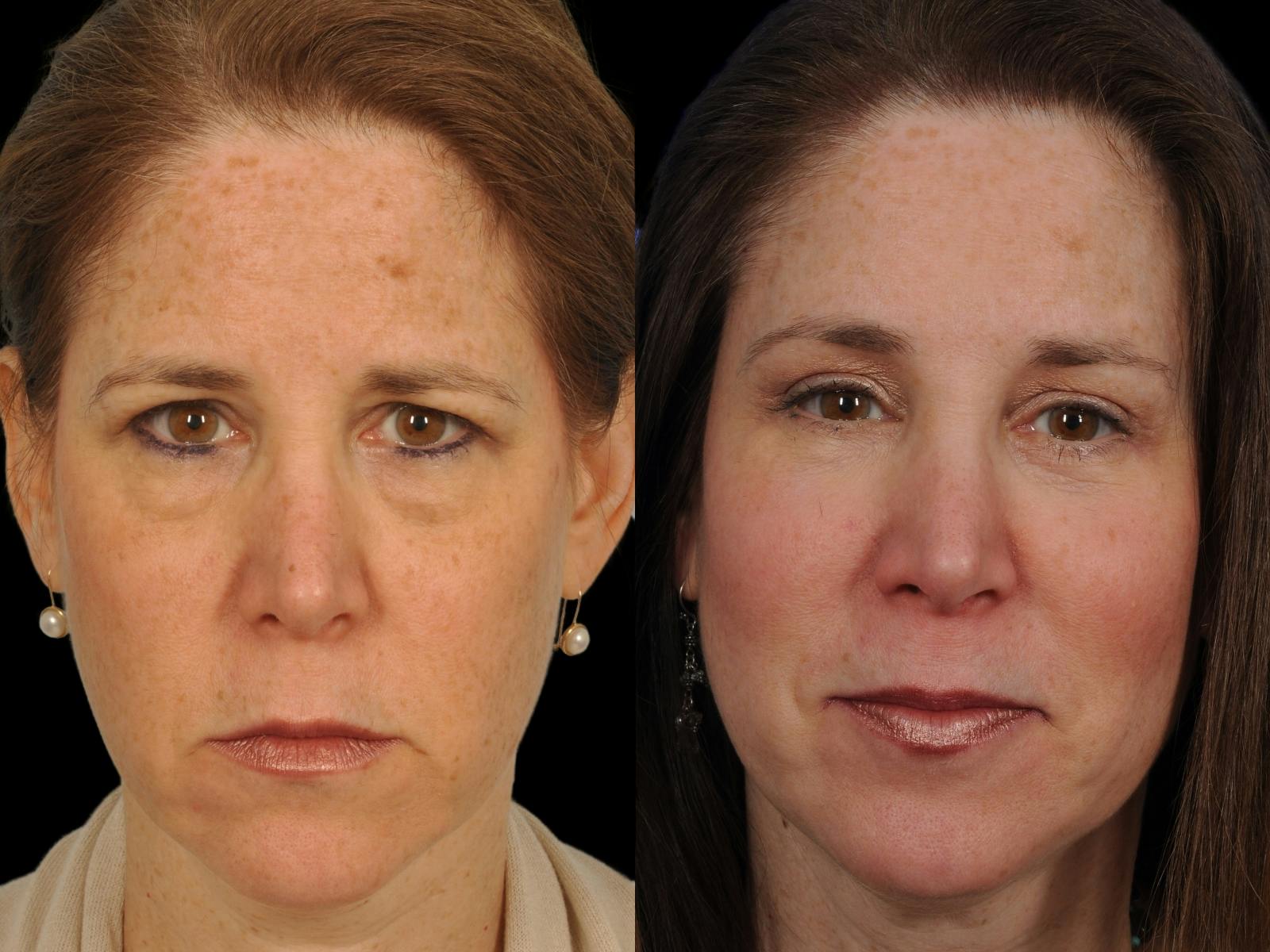 Blepharoplasty Before & After Gallery - Patient 164250 - Image 1