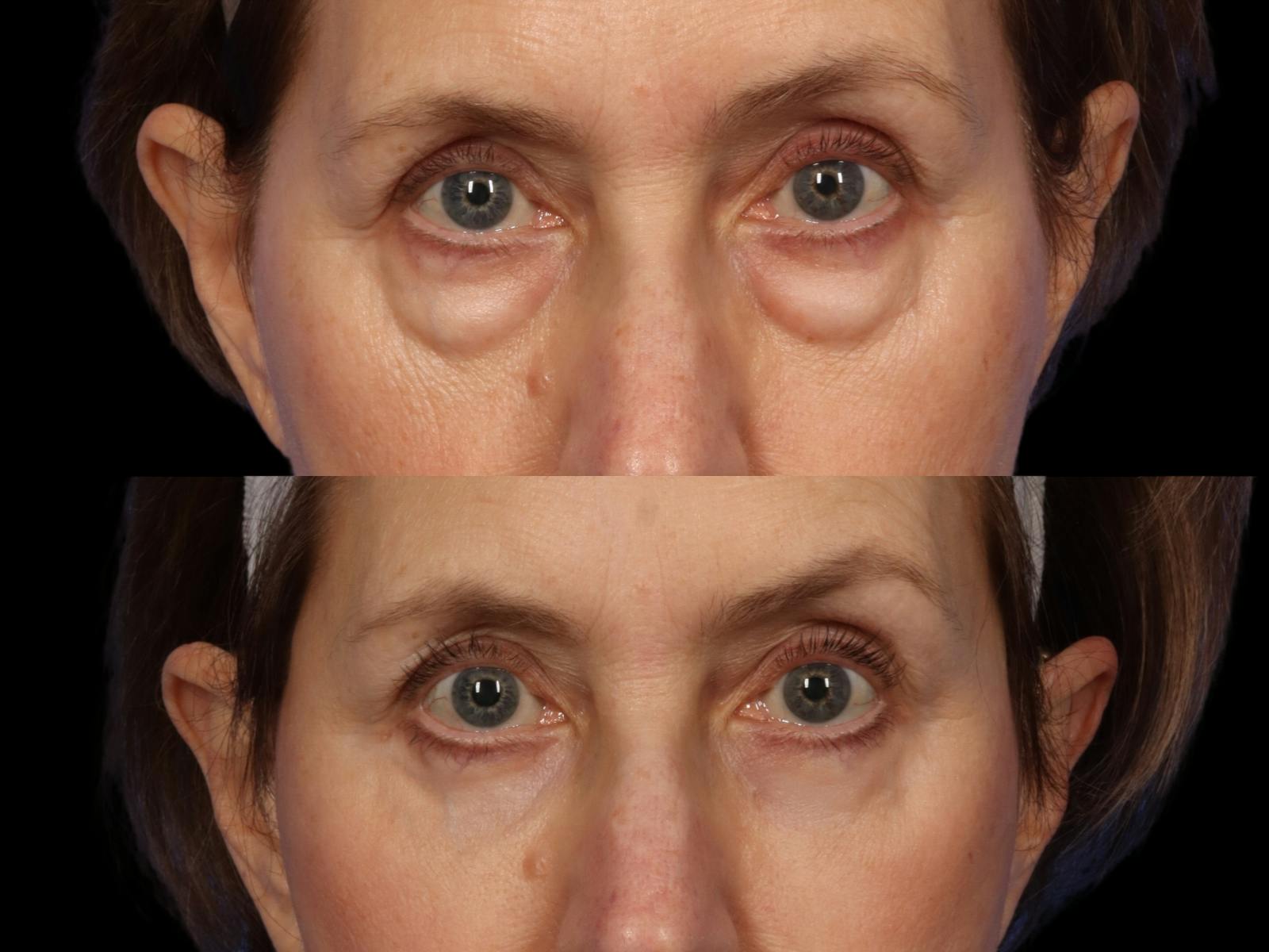 Facelift Before & After Gallery - Patient 648558 - Image 6