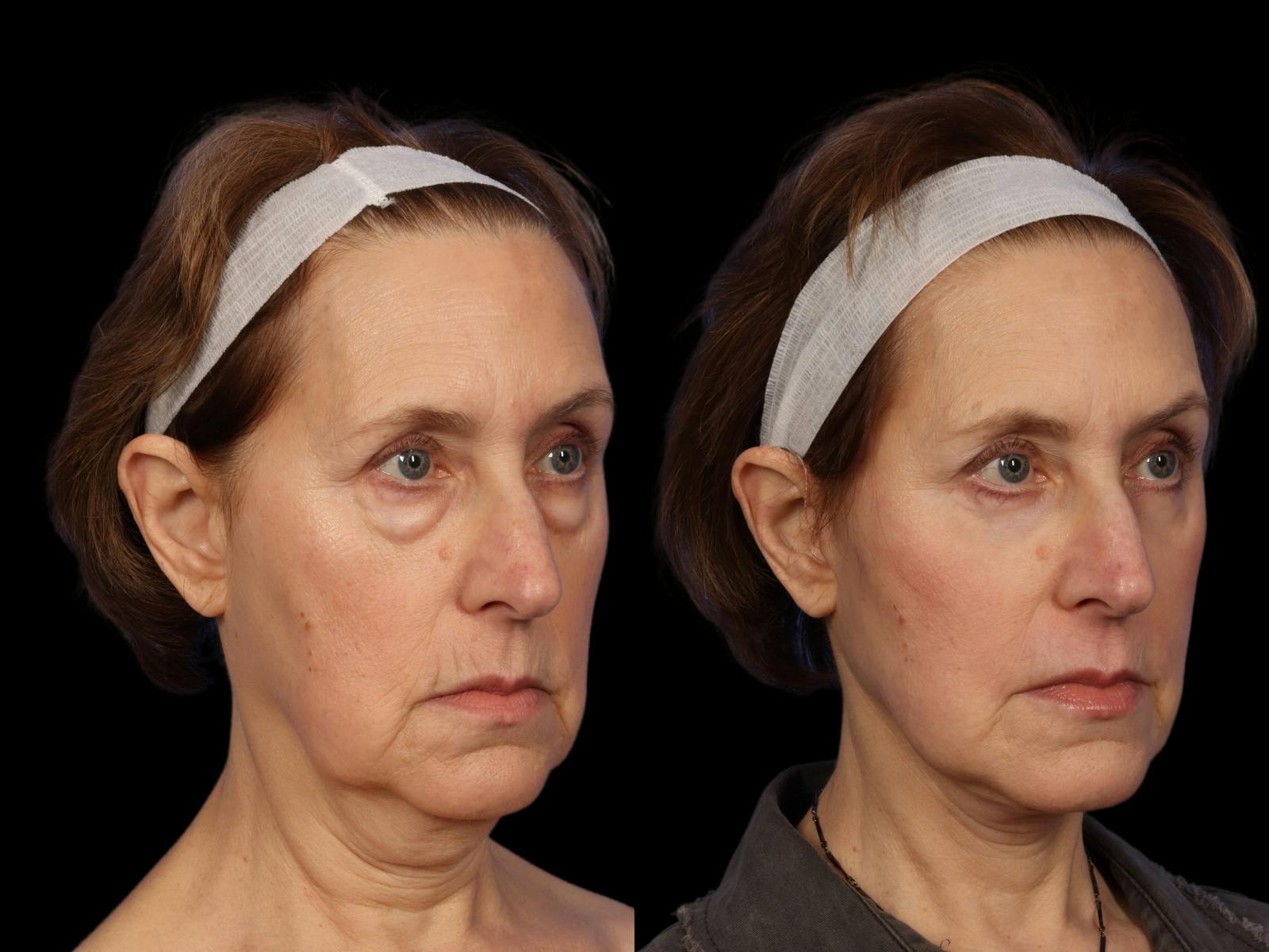 Facelift Before & After Gallery - Patient 648558 - Image 5