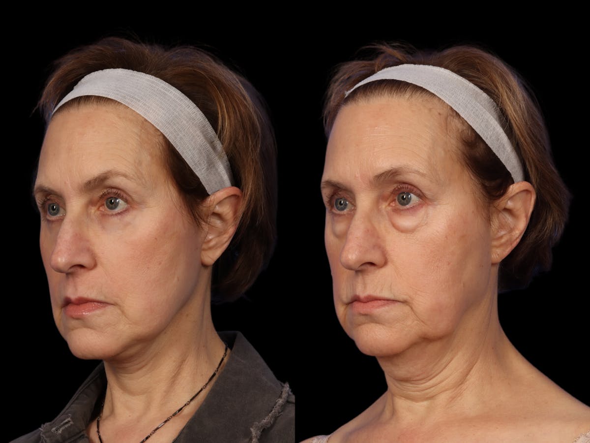 Facelift Before & After Gallery - Patient 648558 - Image 2