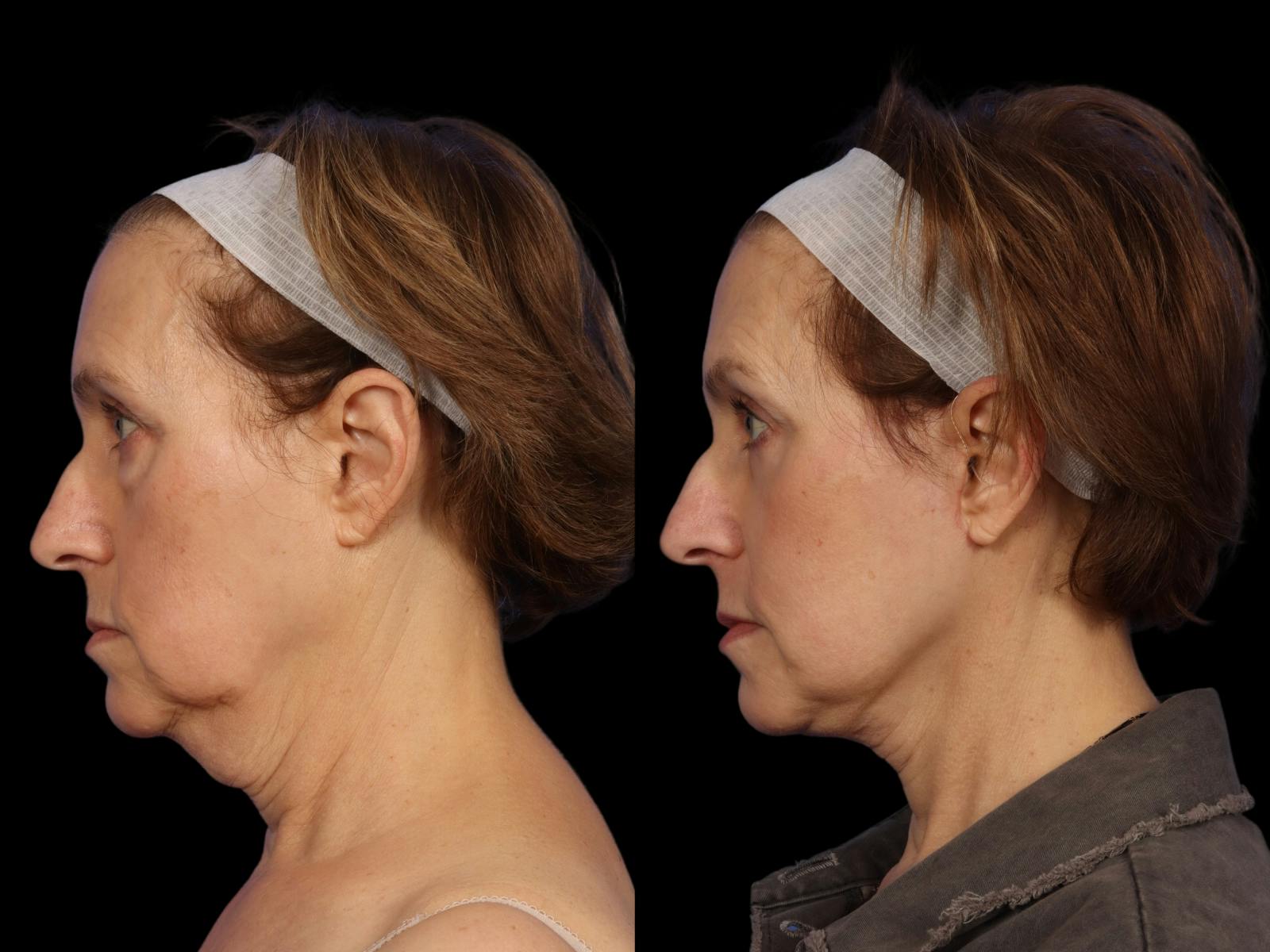 Facelift Before & After Gallery - Patient 648558 - Image 3