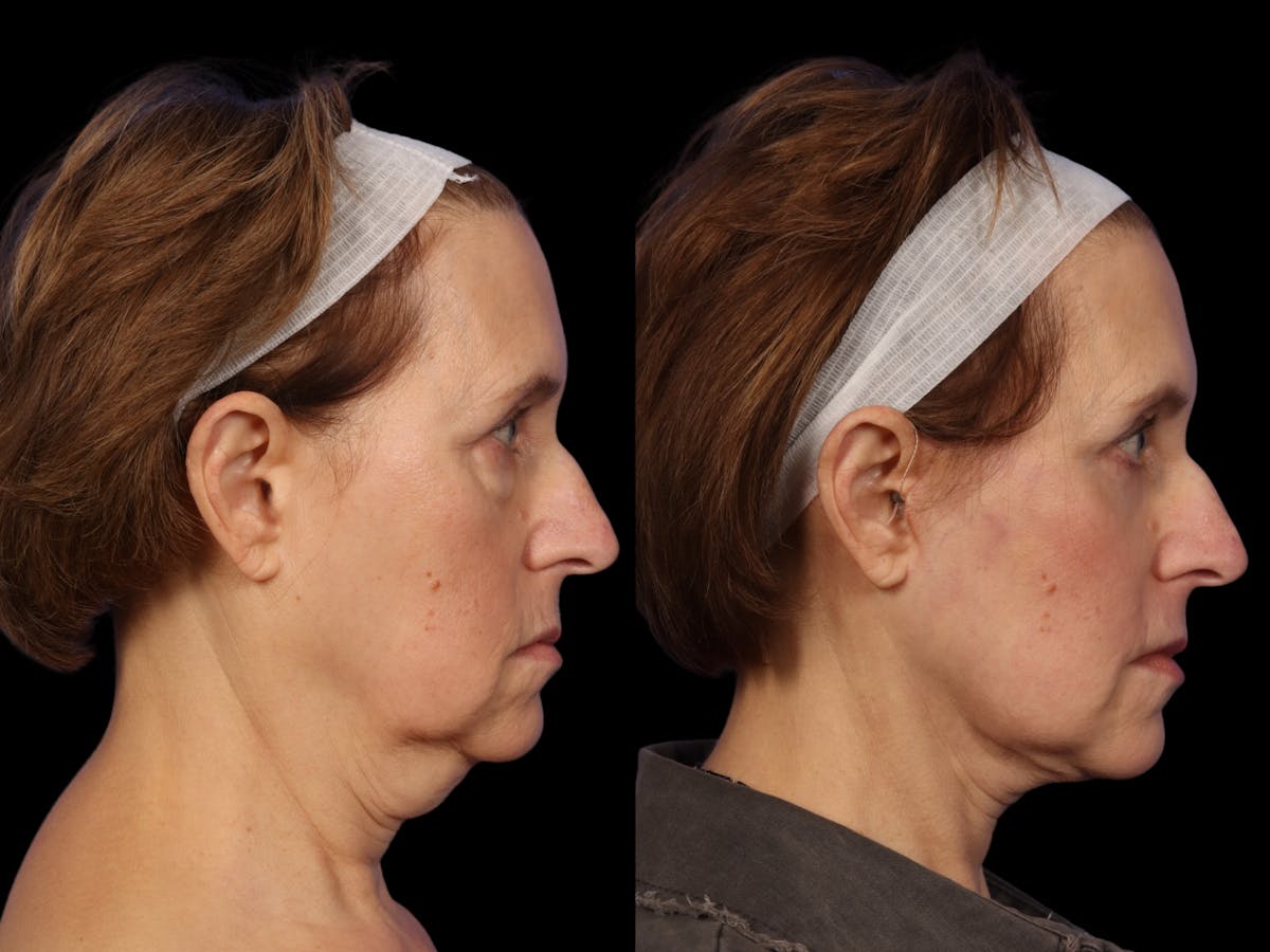 Facelift Before & After Gallery - Patient 648558 - Image 4