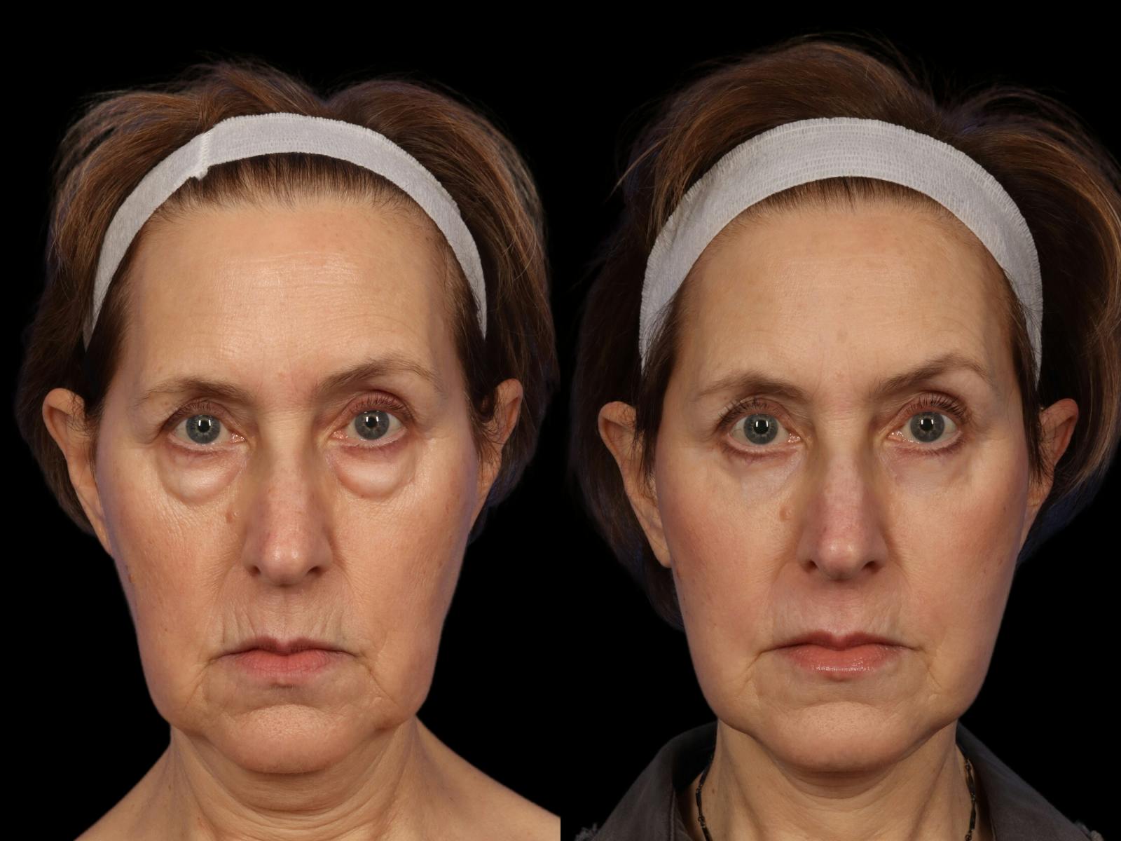 Facelift Before & After Gallery - Patient 648558 - Image 1