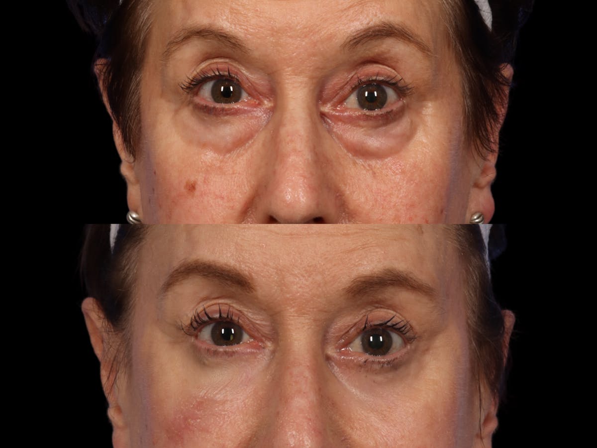 Blepharoplasty Before & After Gallery - Patient 113488 - Image 1