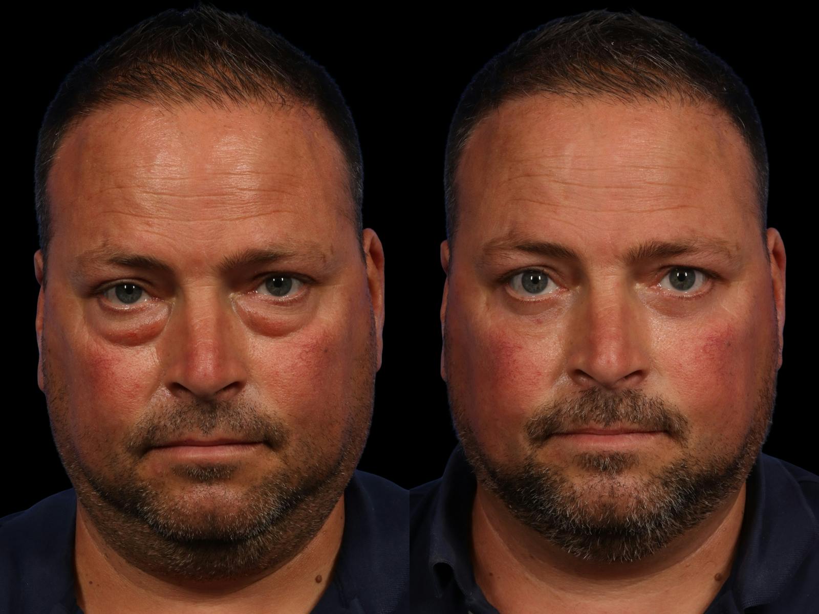 Blepharoplasty Before & After Gallery - Patient 313765 - Image 1