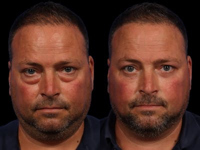 Blepharoplasty Before & After Gallery - Patient 313765 - Image 1