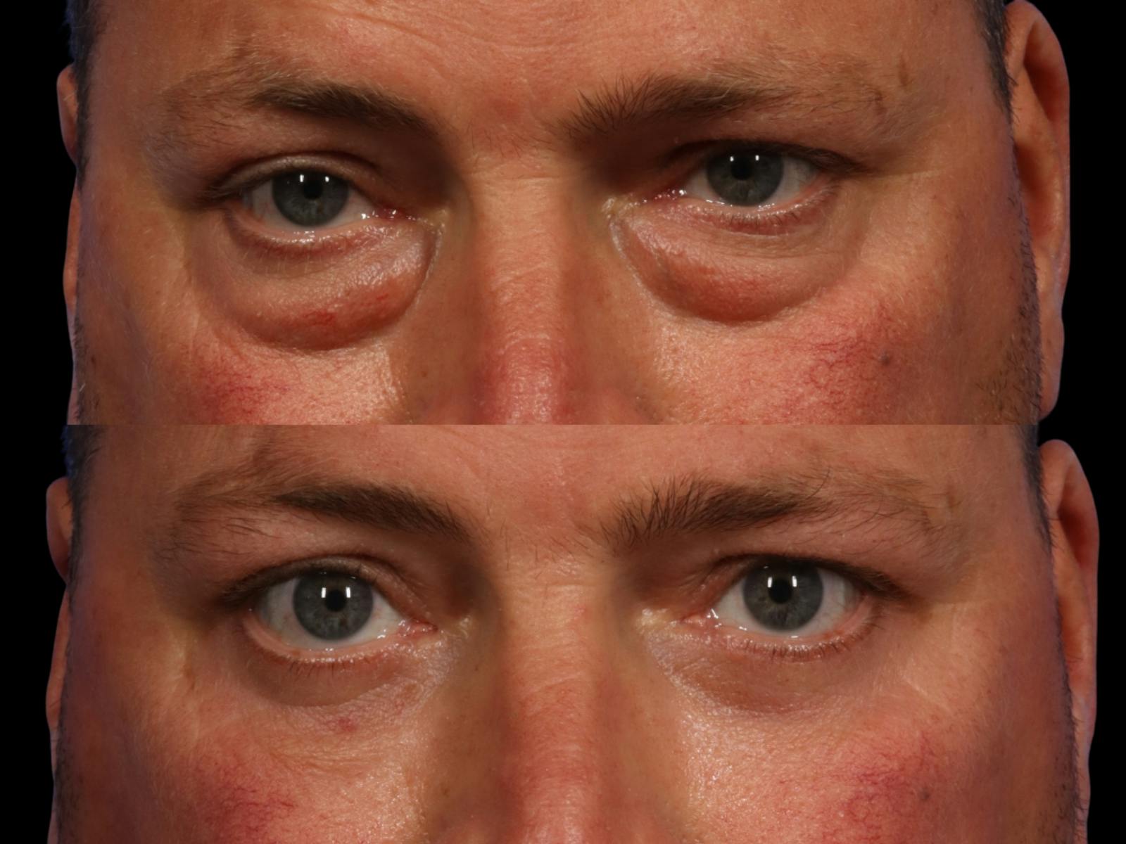 Blepharoplasty Before & After Gallery - Patient 313765 - Image 2