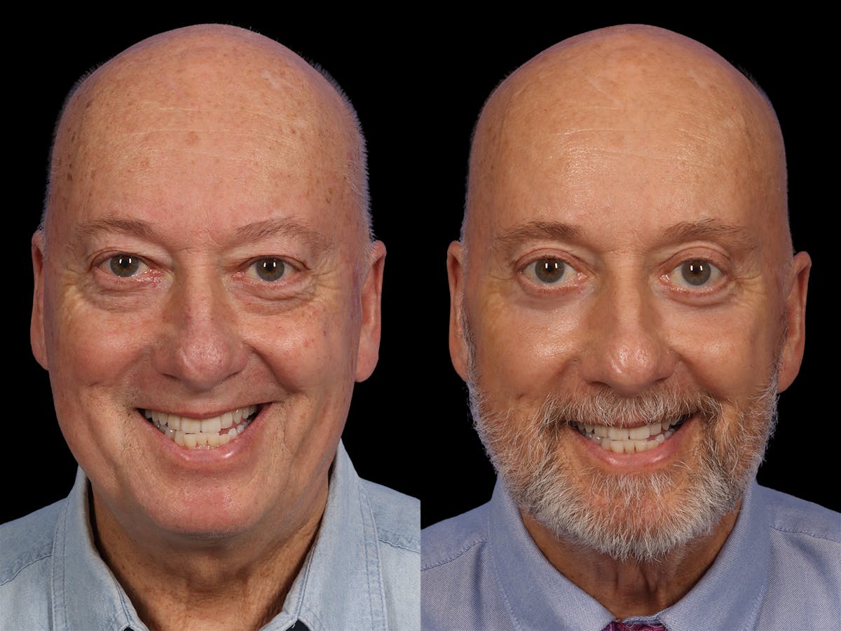 Liposculpture Before & After Gallery - Patient 254724 - Image 2