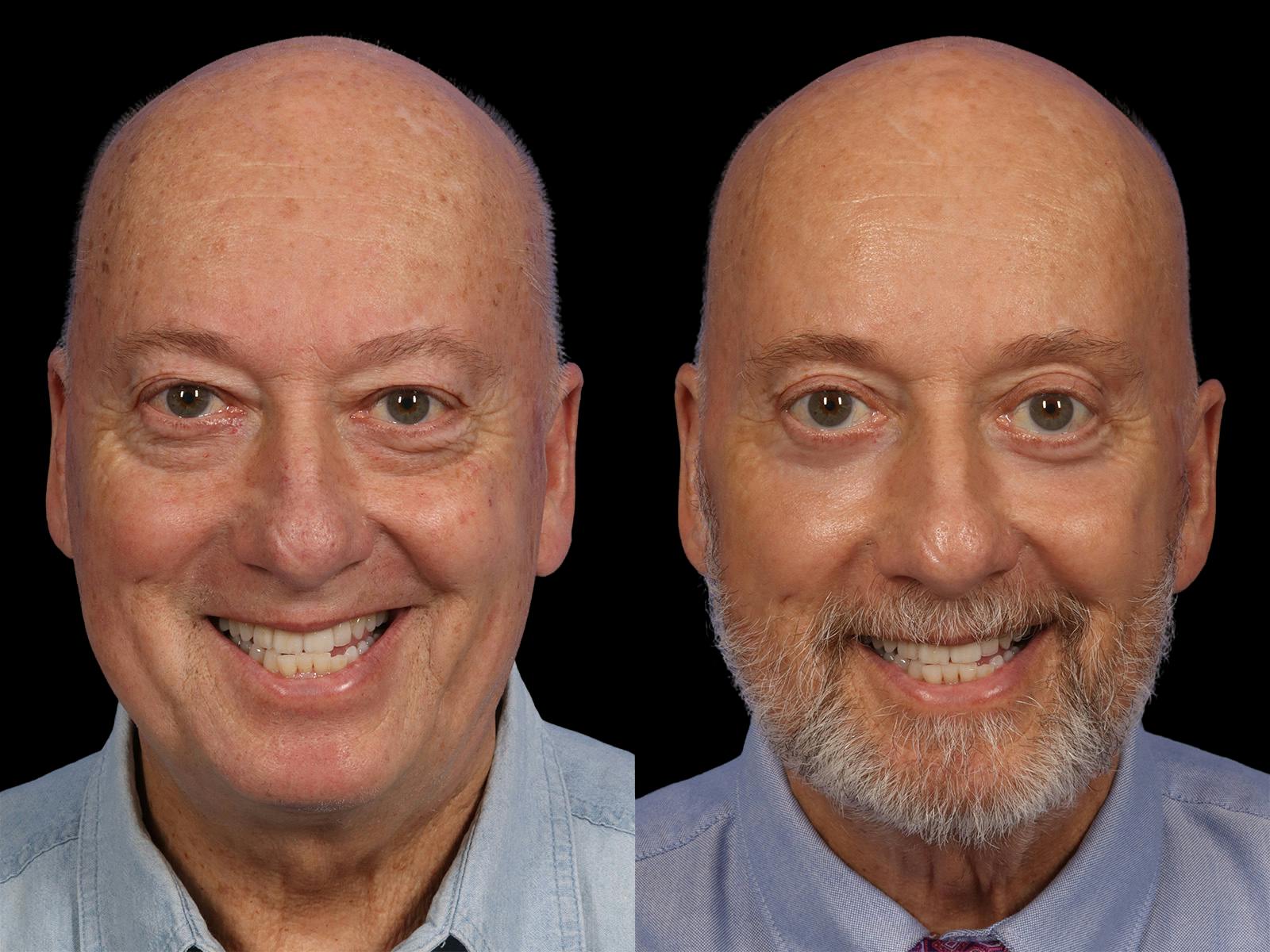 Liposculpture Before & After Gallery - Patient 254724 - Image 2