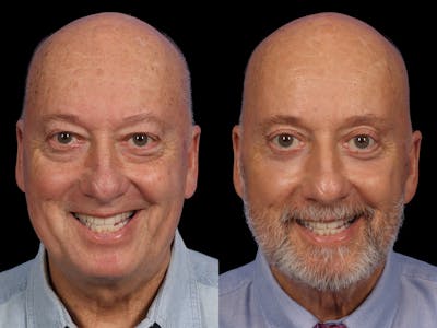 Blepharoplasty Before & After Gallery - Patient 539251 - Image 1