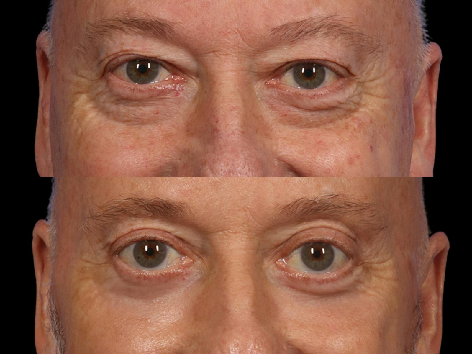 Blepharoplasty Before & After Gallery - Patient 539251 - Image 2