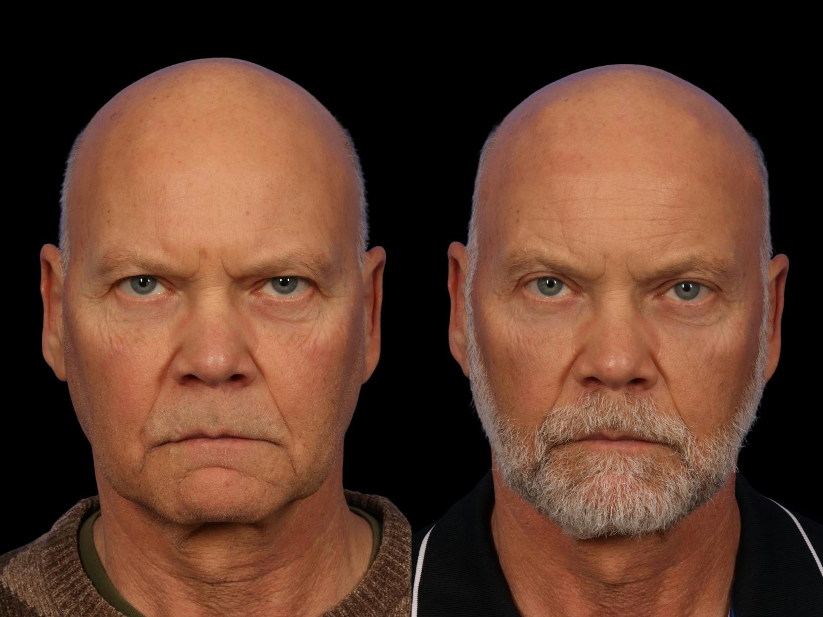 Brow Lift Before & After Gallery - Patient 261756 - Image 1