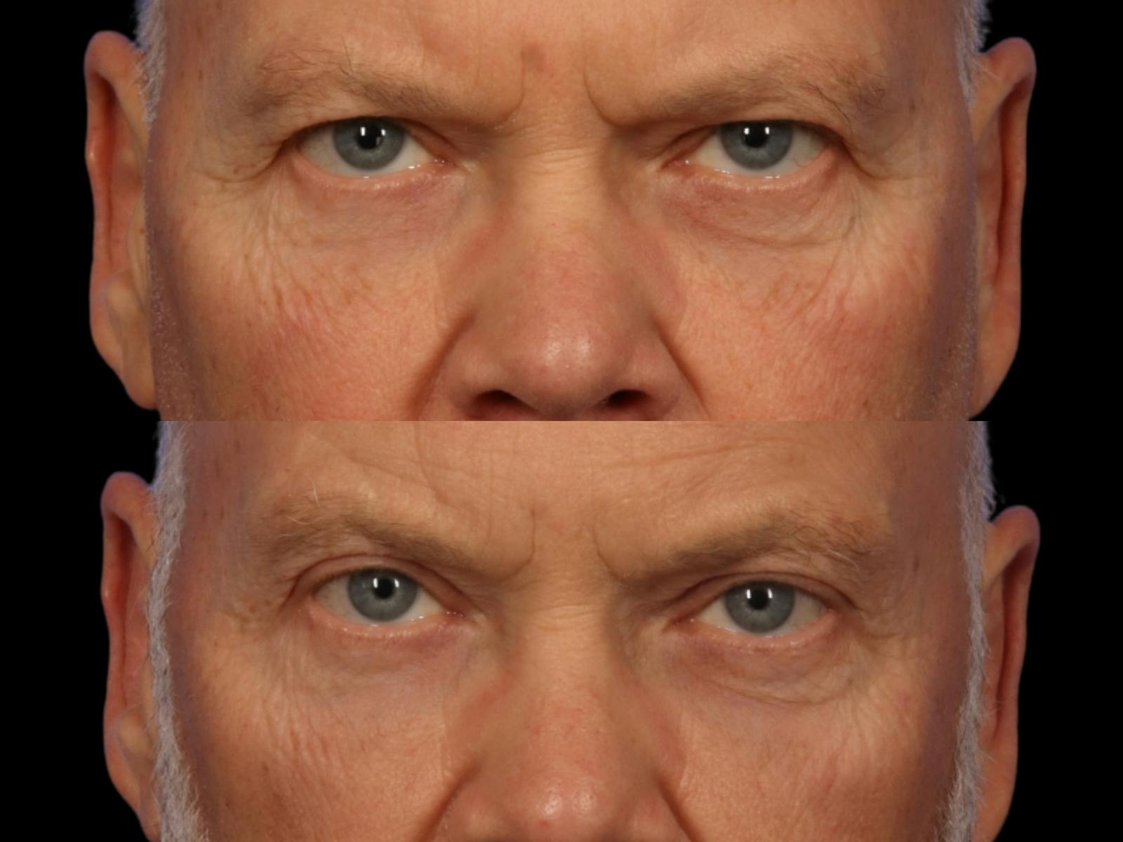 Brow Lift Before & After Gallery - Patient 261756 - Image 2