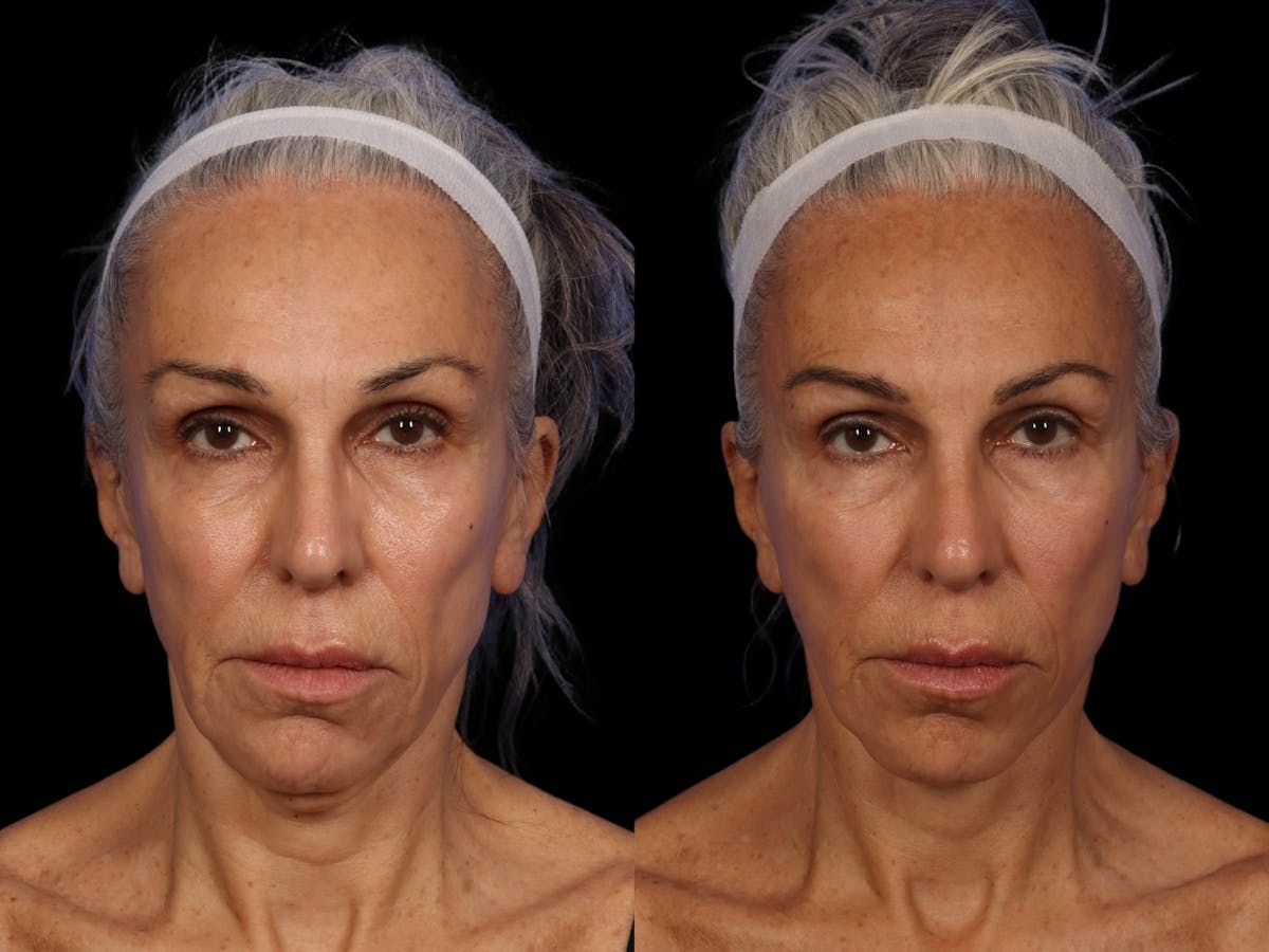 Liposculpture Before & After Gallery - Patient 726358 - Image 1