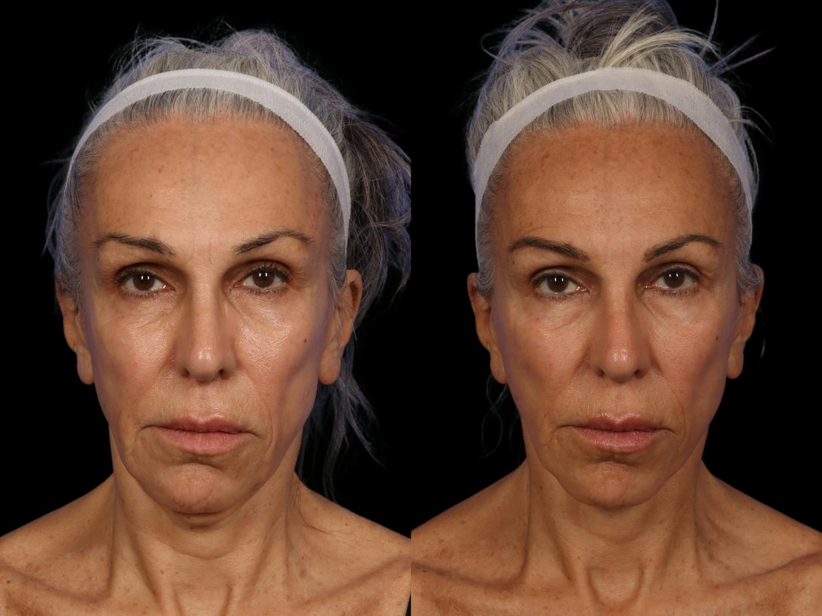 Chin Implant Before & After Gallery - Patient 882928 - Image 1