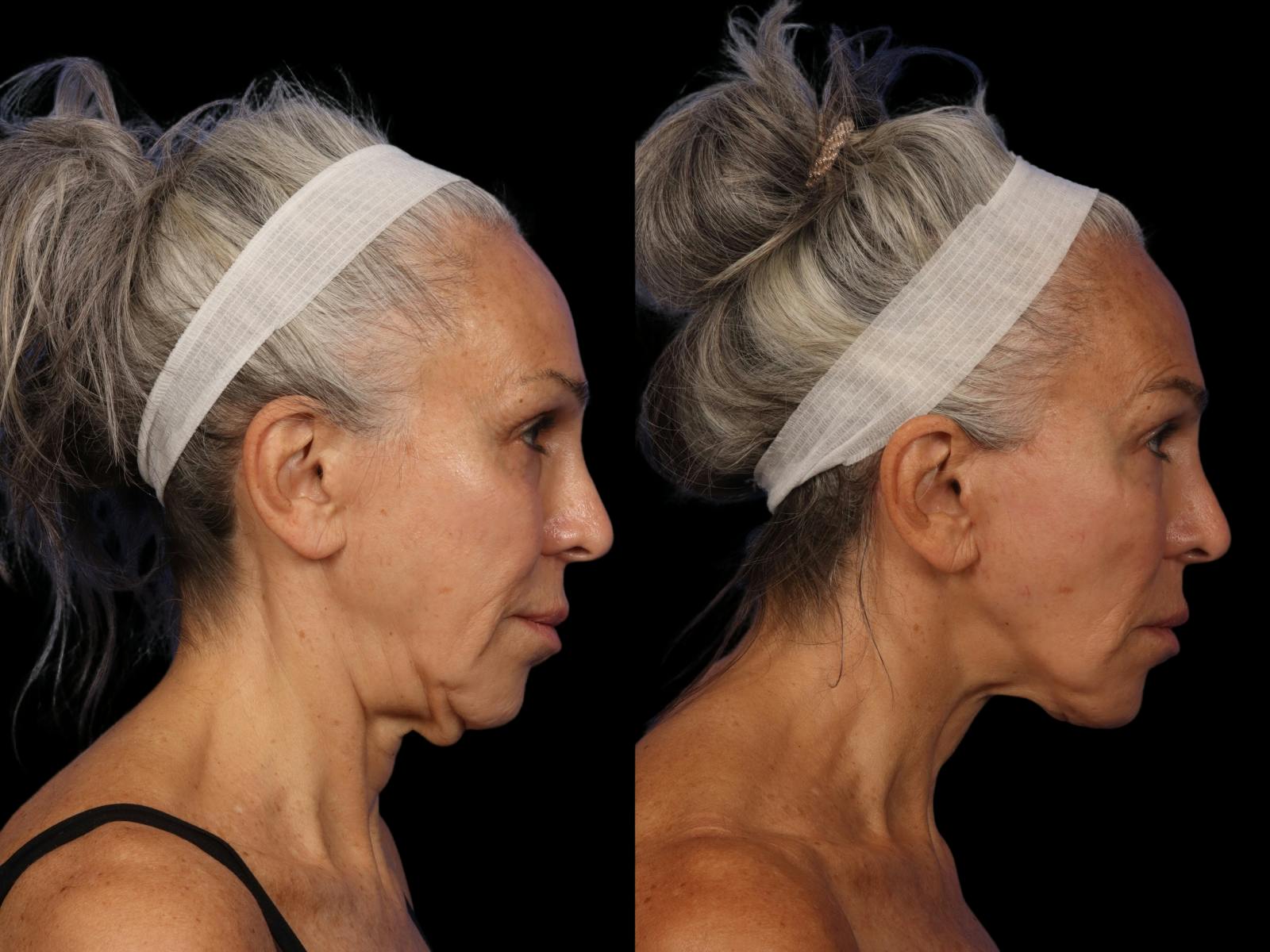 Fillers Before & After Gallery - Patient 374940 - Image 2