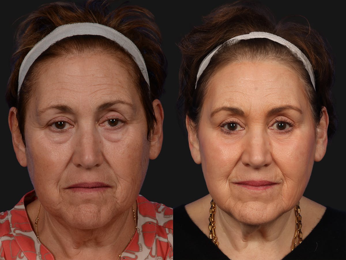 Liposculpture Before & After Gallery - Patient 218506 - Image 1