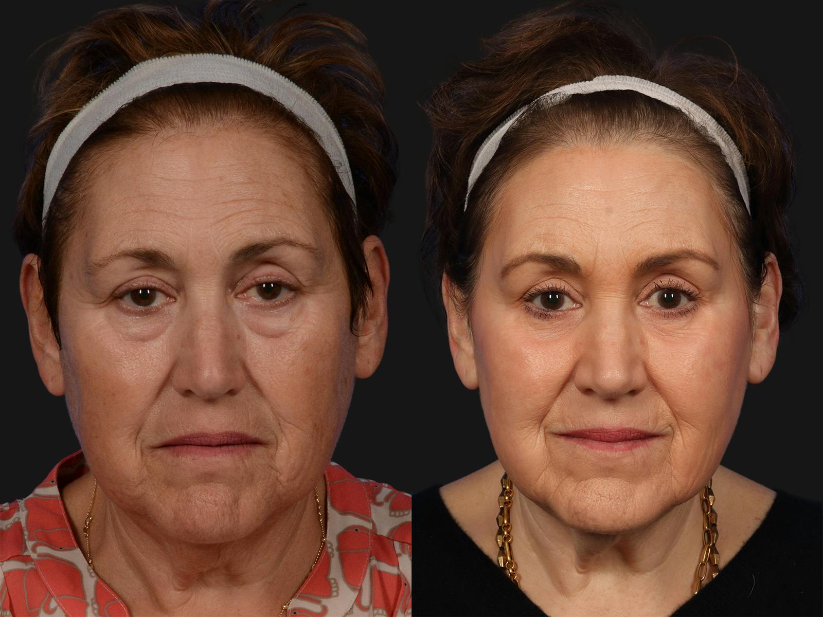 Liposculpture Before & After Gallery - Patient 218506 - Image 1