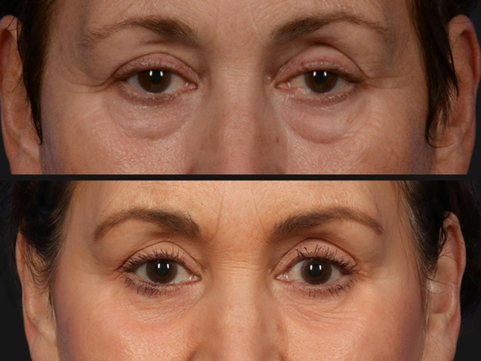 Blepharoplasty Before & After Gallery - Patient 113547 - Image 2