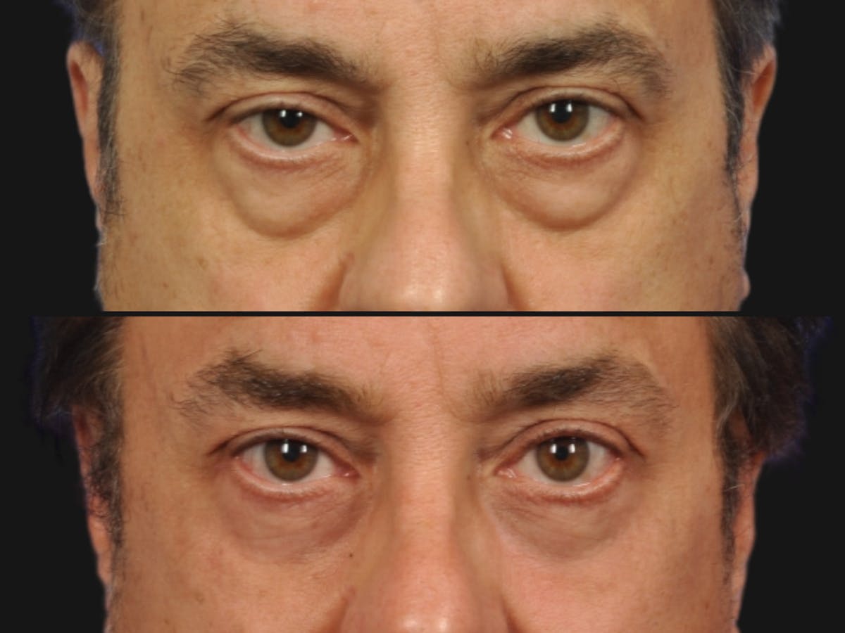 Blepharoplasty Before & After Gallery - Patient 275106 - Image 2