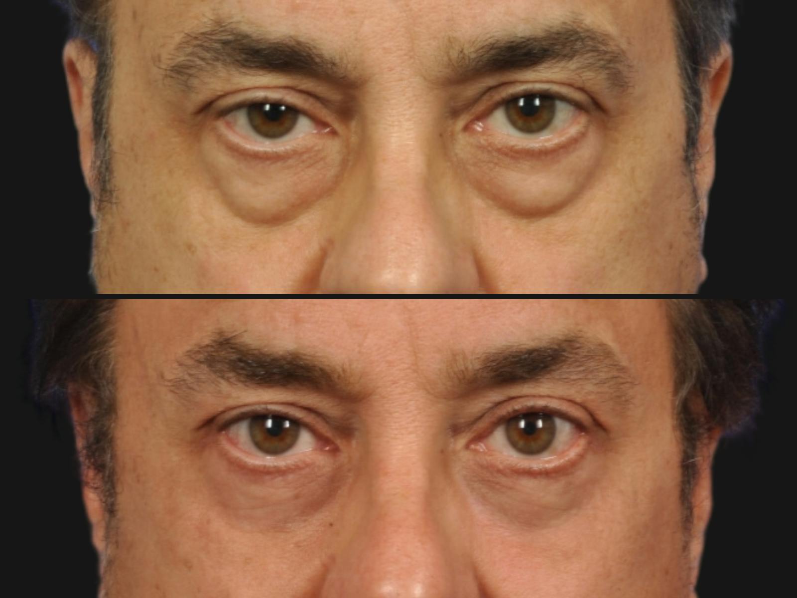 Blepharoplasty Before & After Gallery - Patient 275106 - Image 2