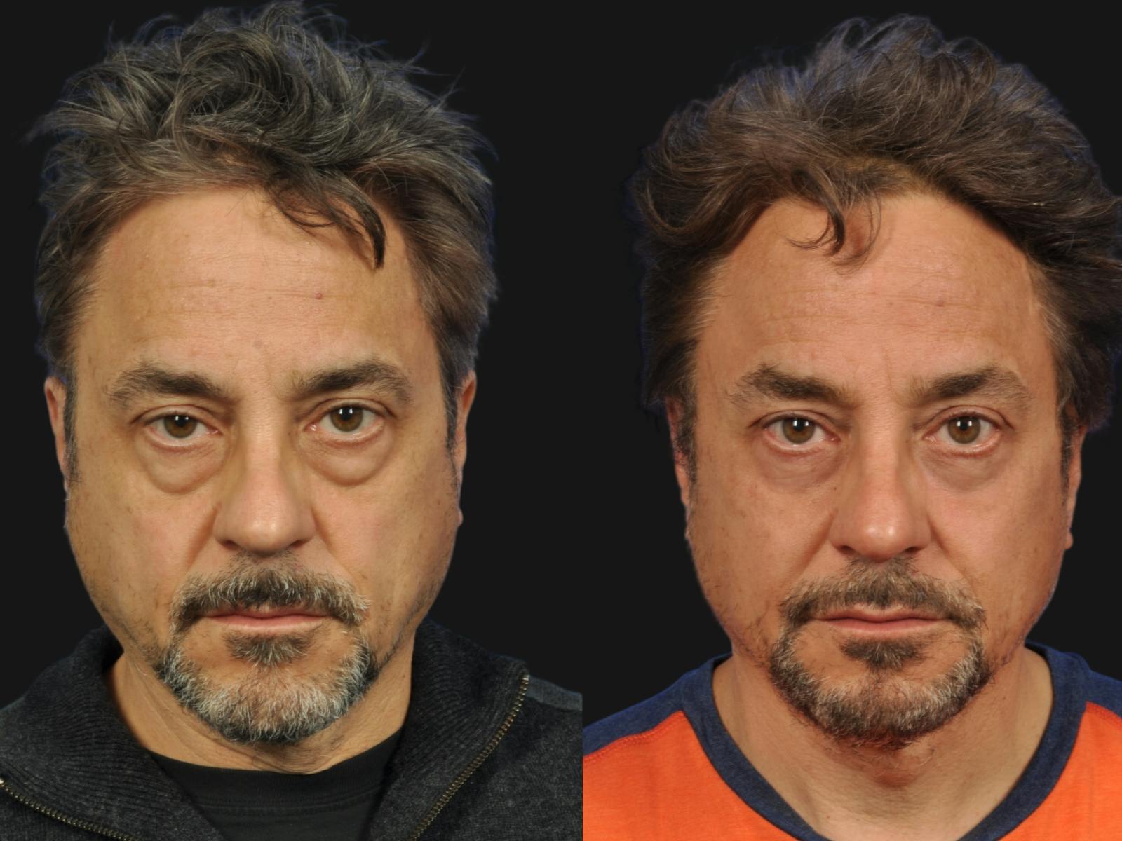 Blepharoplasty Before & After Gallery - Patient 275106 - Image 1