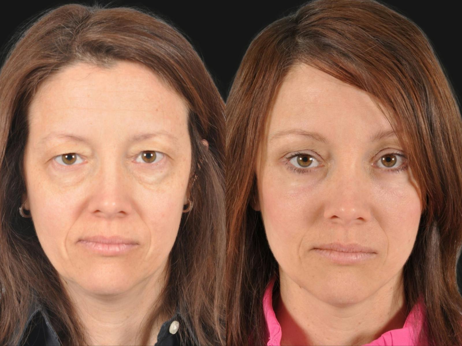 Blepharoplasty Before & After Gallery - Patient 216405 - Image 1