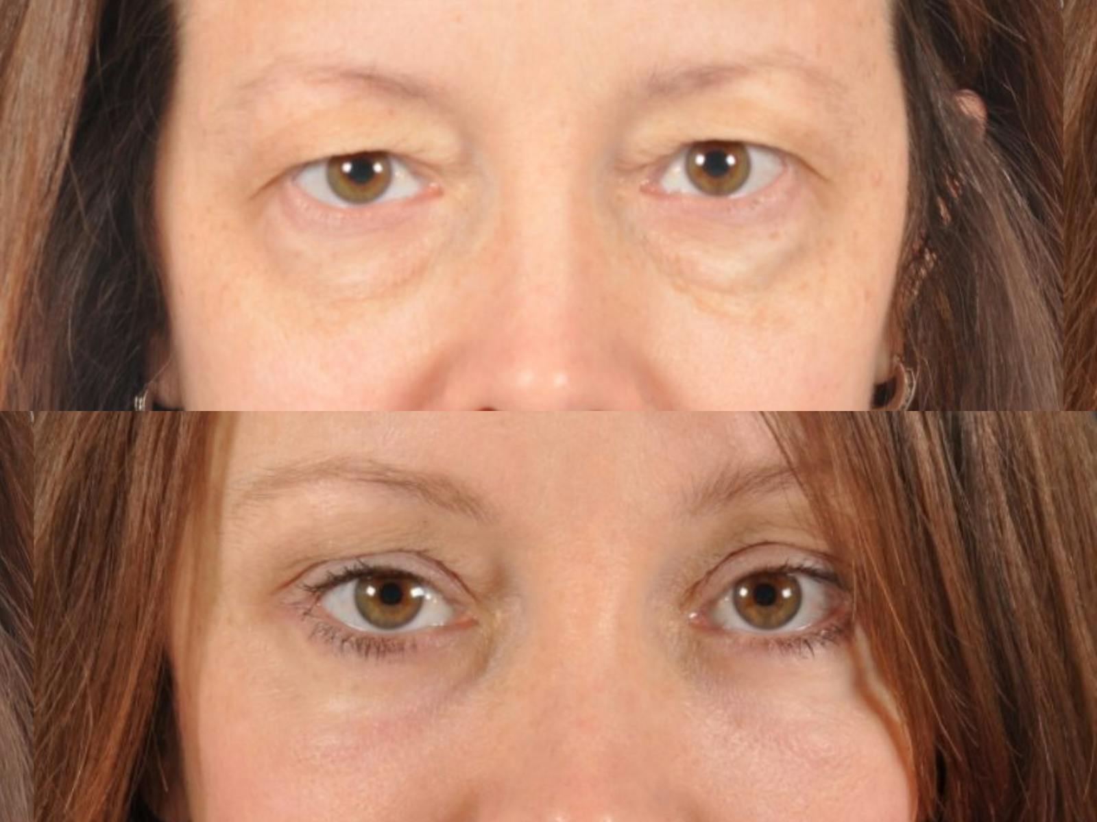 Blepharoplasty Before & After Gallery - Patient 216405 - Image 2