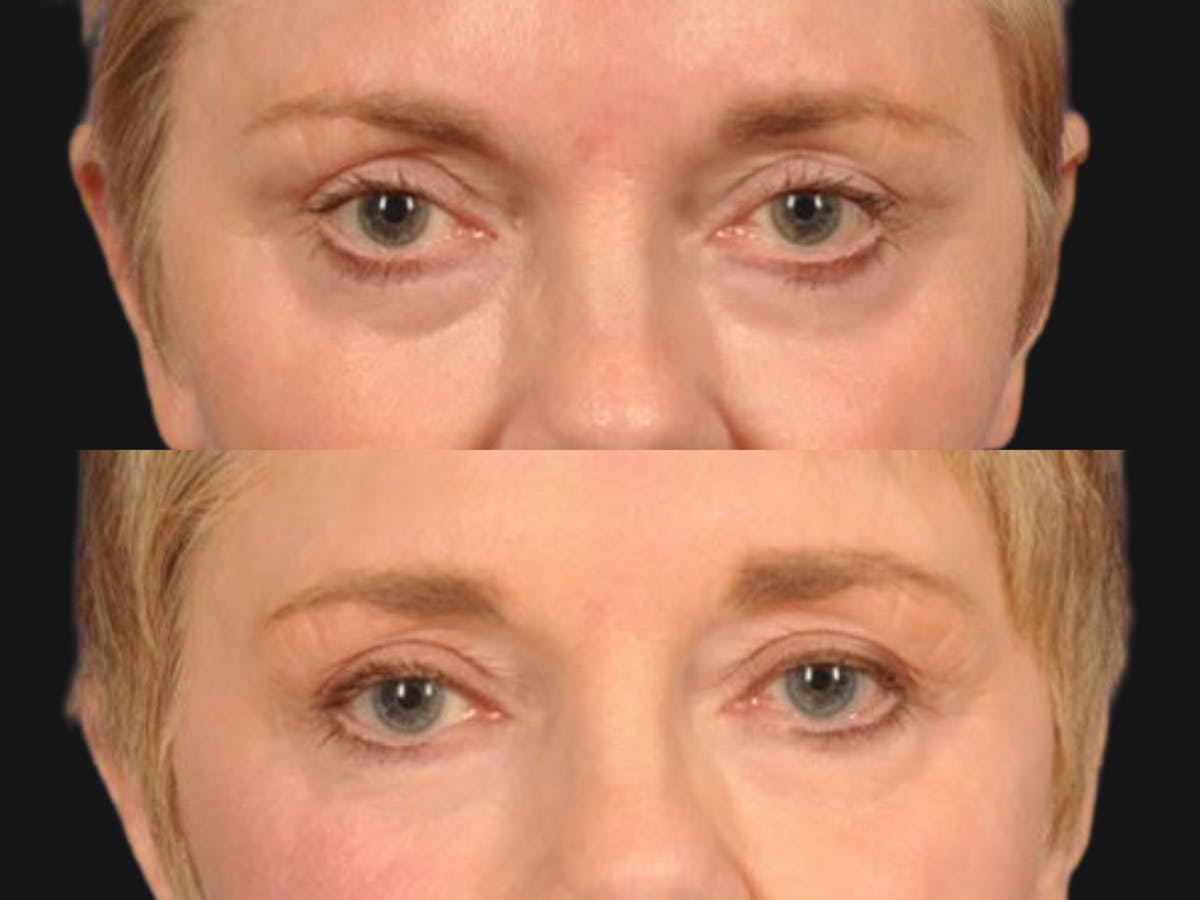 Brow Lift Before & After Gallery - Patient 337875 - Image 2