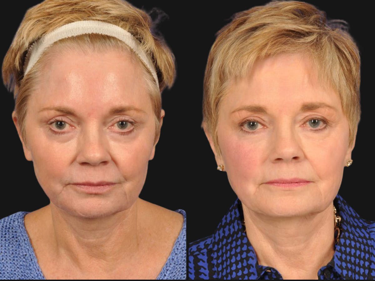 Brow Lift Before & After Gallery - Patient 337875 - Image 1