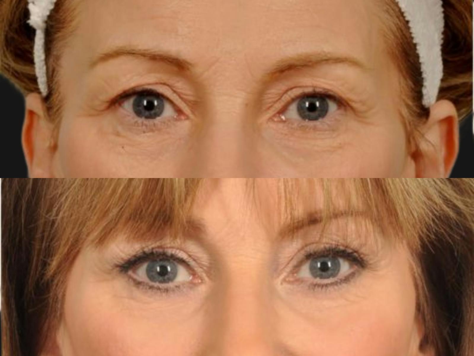 Blepharoplasty Before & After Gallery - Patient 172690 - Image 2
