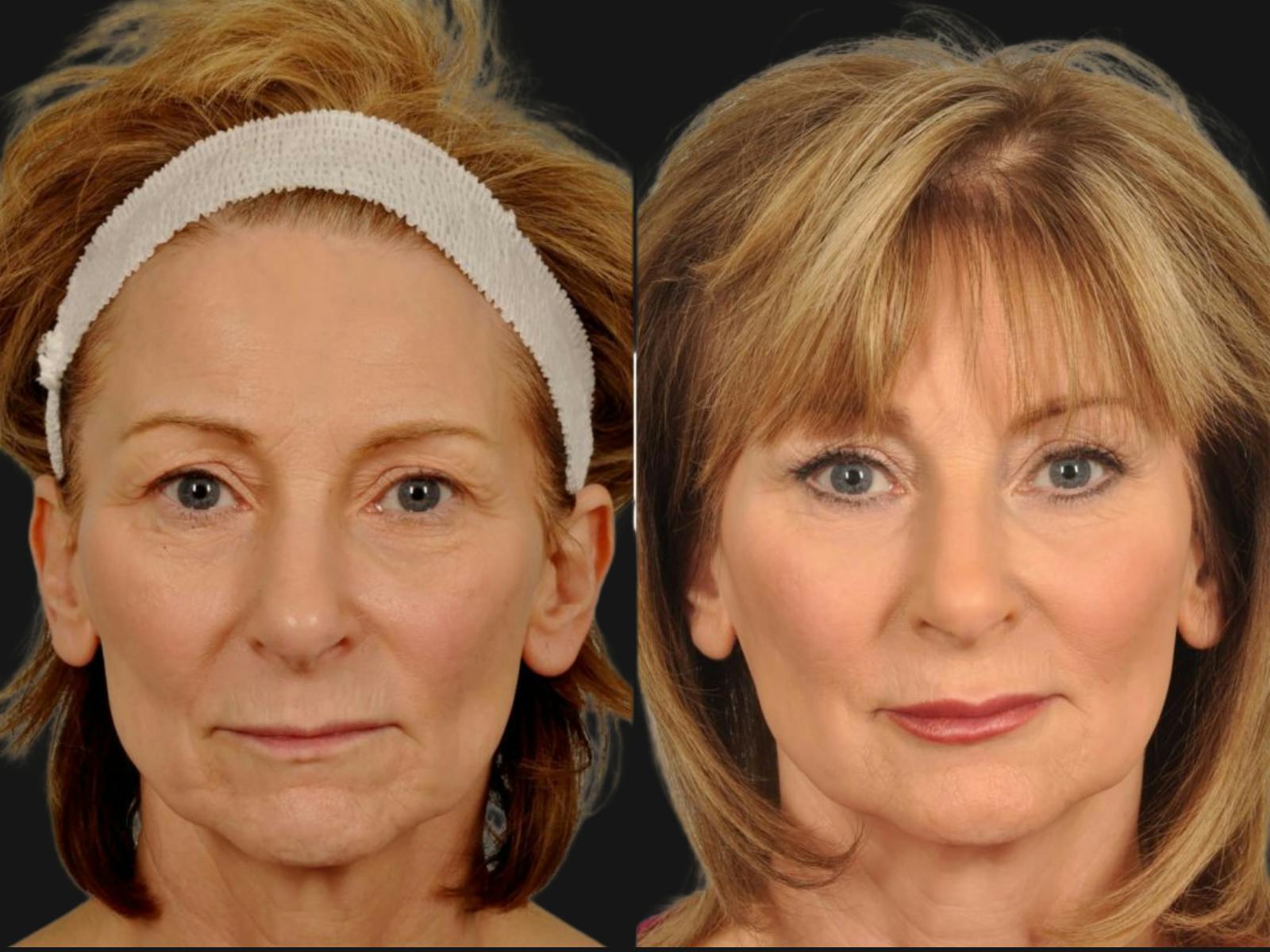 Blepharoplasty Before & After Gallery - Patient 172690 - Image 1