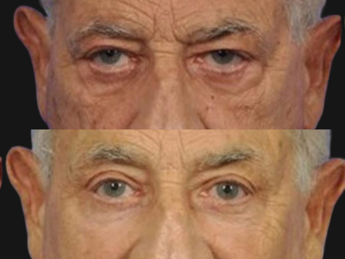 Blepharoplasty Before & After Gallery - Patient 214464 - Image 2