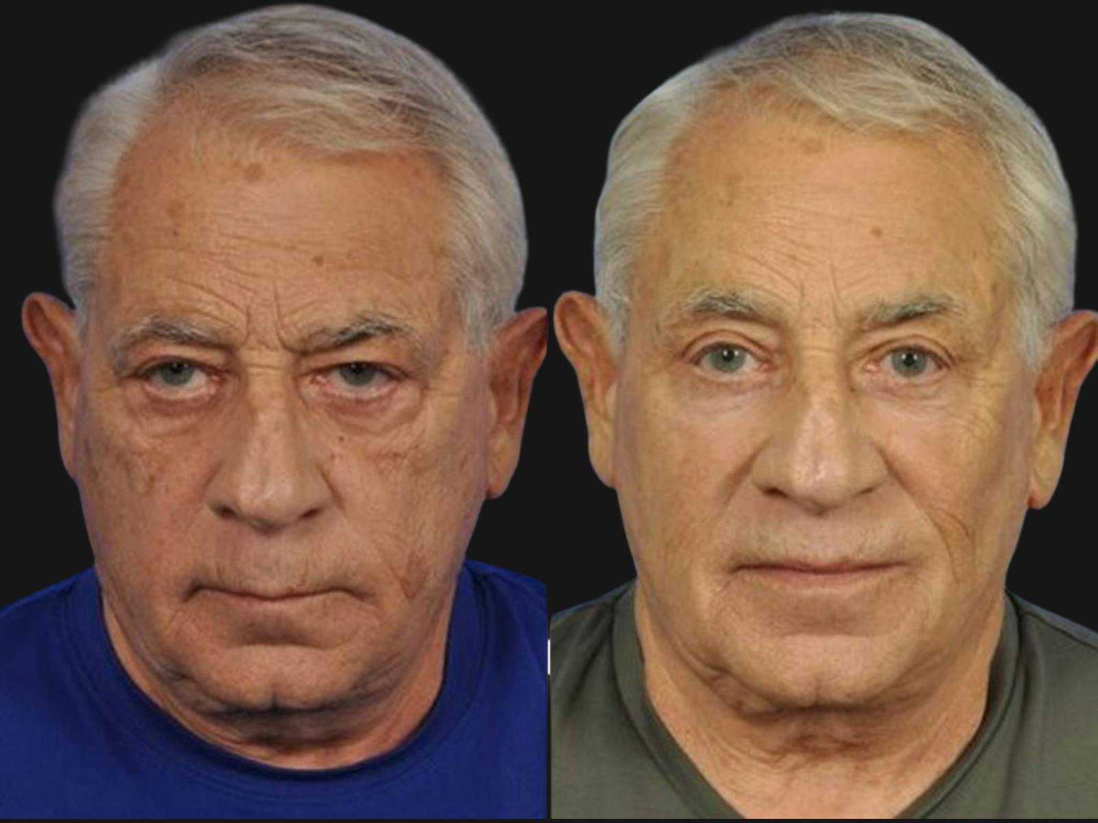 Blepharoplasty Before & After Gallery - Patient 214464 - Image 1