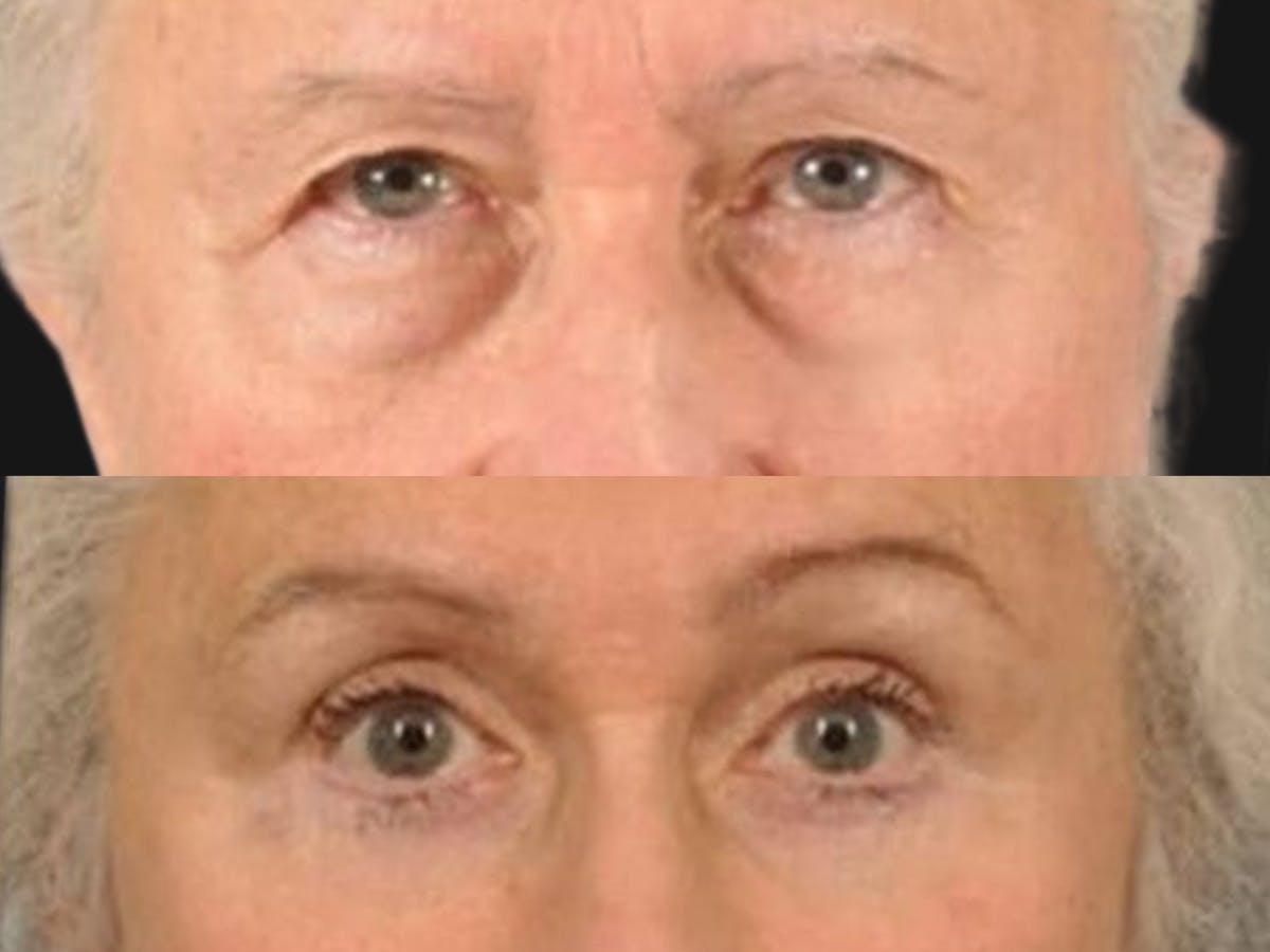 Brow Lift Before & After Gallery - Patient 406913 - Image 2