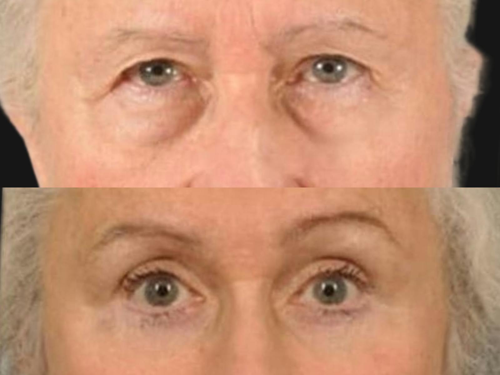 Droopy Eyelids – Ptosis Before & After Gallery - Patient 256070 - Image 2