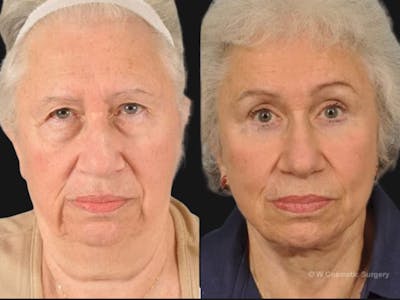 Blepharoplasty Before & After Gallery - Patient 168182 - Image 1