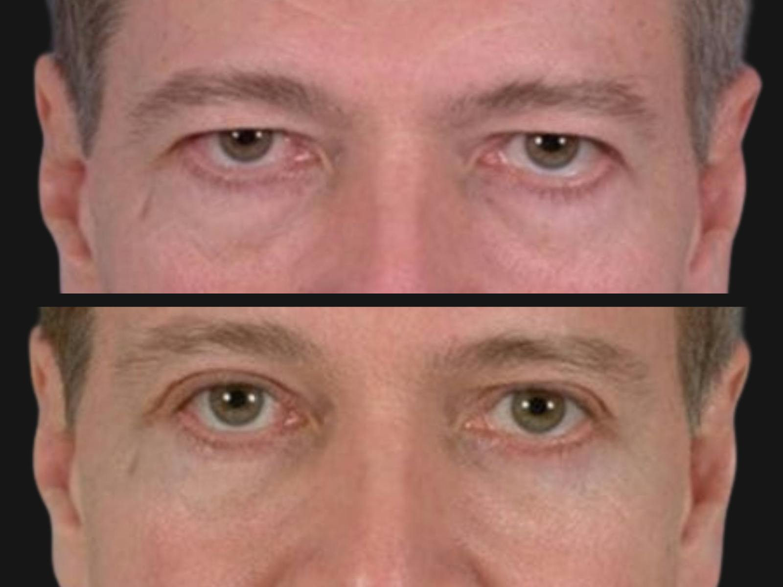 Blepharoplasty Before & After Gallery - Patient 364646 - Image 2