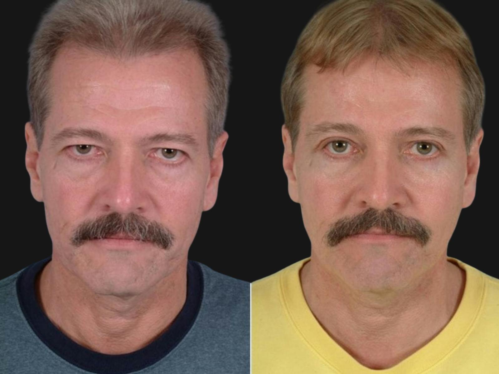 Blepharoplasty Before & After Gallery - Patient 364646 - Image 1