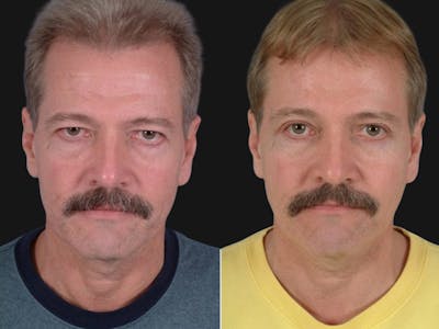 Blepharoplasty Before & After Gallery - Patient 364646 - Image 1